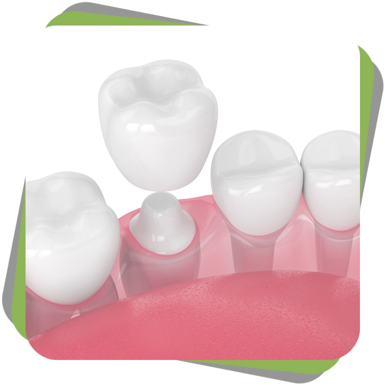 zęby zrobione pod licówki